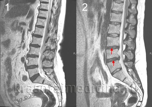 Bizkarrezurraren osteokondrosia