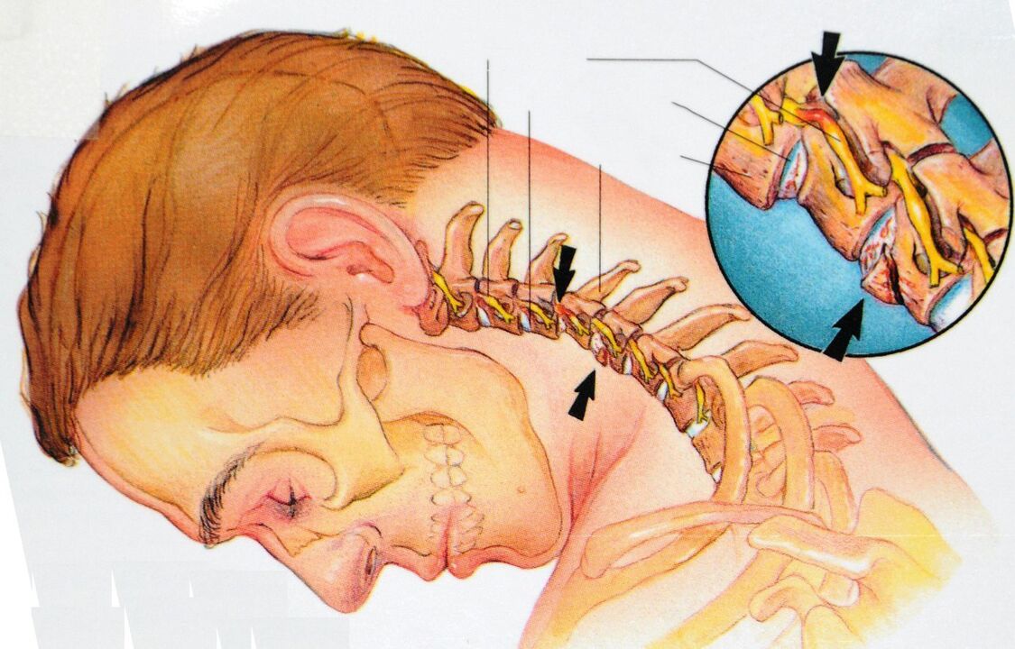 Cervical eskualdeko osteokondrosia
